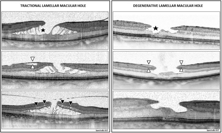 Lamellar Hole Oct Morphologic Stages Of Full Thickness Macular Hole On