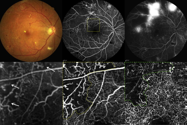 optical coherence tomography diabetic retinopathy