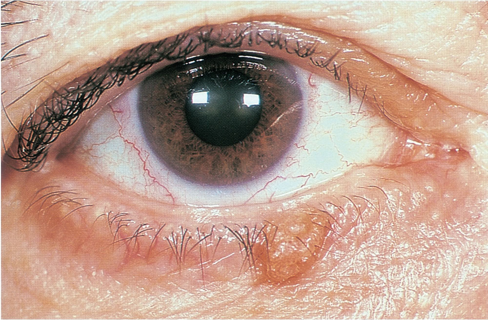 Eyelid Margin Disease Types And Treatment