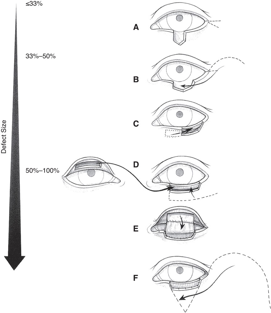 Classification And Management Of Eyelid Disorders | Ento Key