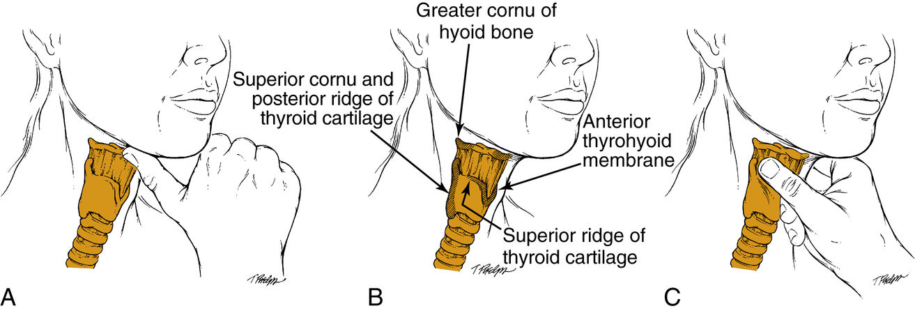 Laryngology | Ento Key