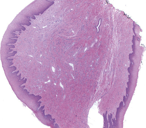 irritation fibroma histology