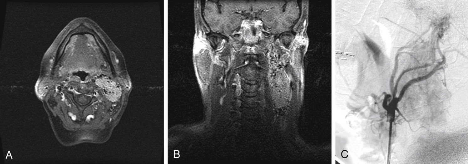 Head And Neck Radiology | Ento Key