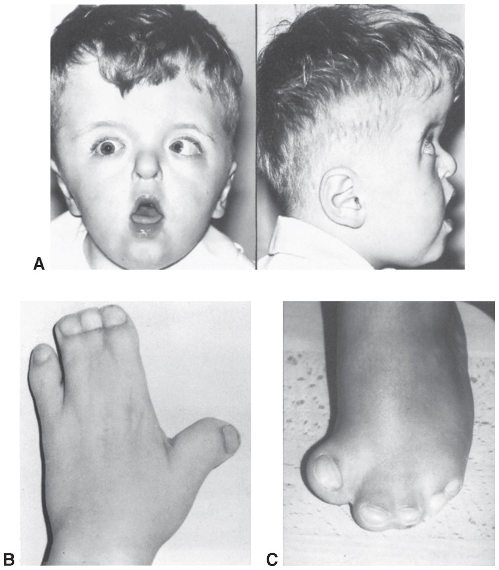 Orbital Disorders | Ento Key