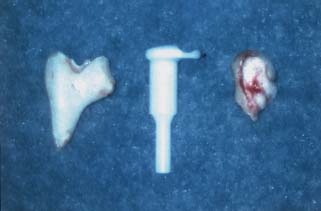 Tympanoplasty Ossicular Chain Reconstruction