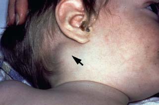 mastoiditis symptoms