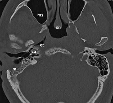 Eustachian Tube Problems