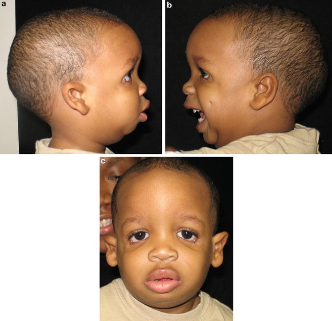 Genetics of Common Congenital Syndromes of the Head and Neck 