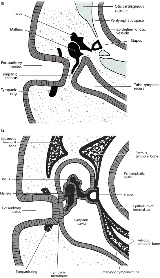 Congenital stapes suprastructure fixation presenting with