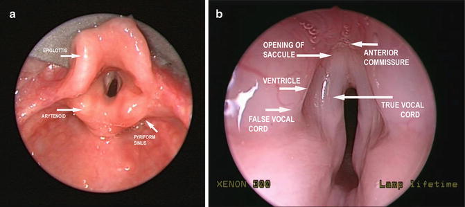 anterior commissure larynx