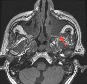 Fungal sinusitis deals