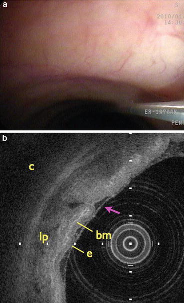 icd 10 pcs code for optical coherence tomography