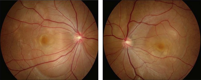 Vogt–Koyanagi–Harada Disease | Ento Key