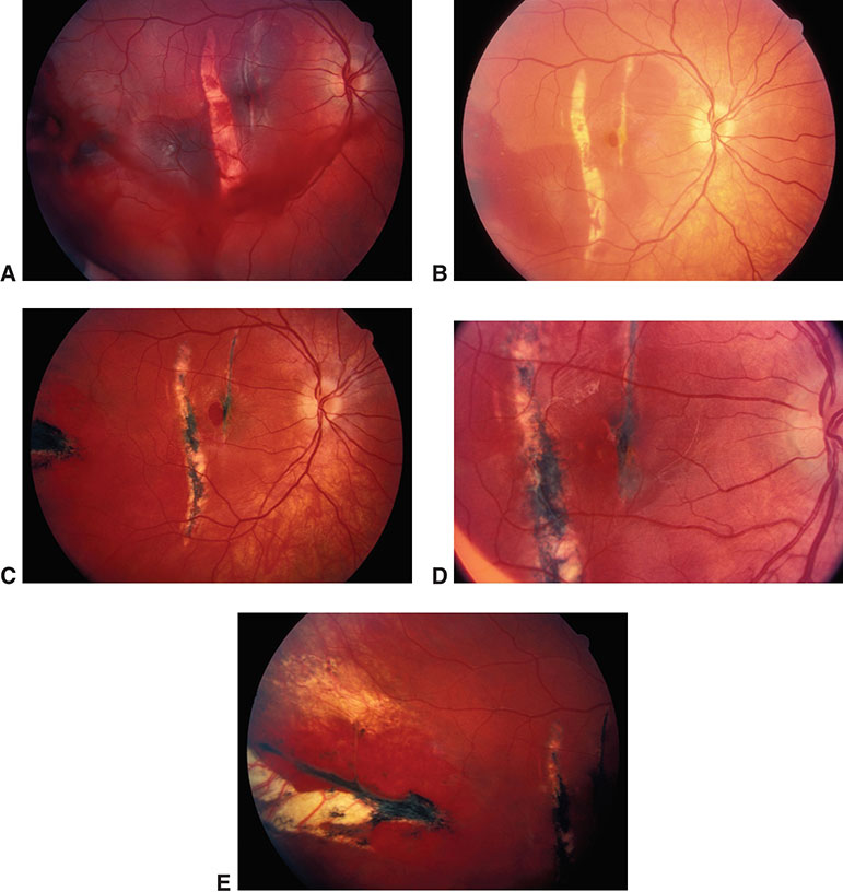 Figure 17 4 Blunt Ocular Trauma With Traumatic Choroidal Rupture Subretinal Hemorrhage Macular Hole And Retinal Sclopetaria Figure 17 4 Blunt Ocular Trauma With Traumatic Choroidal Rupture Subretinal Hemorrhage Macular Hole And Retinal Sclopetaria