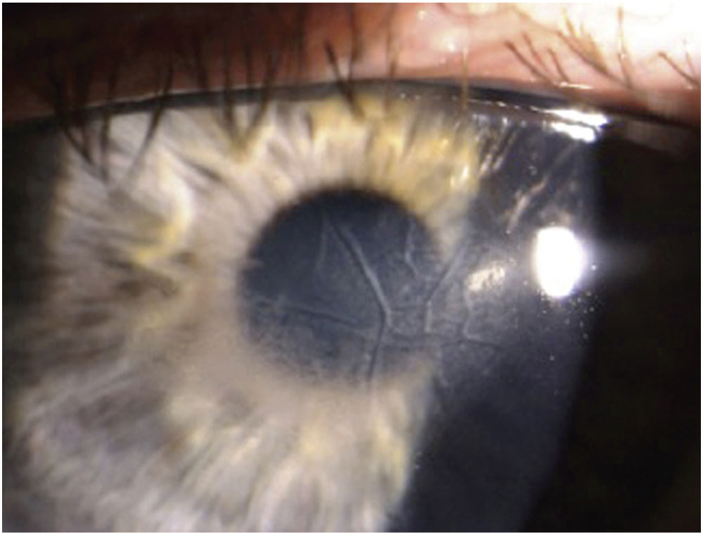 Photoablation Plications And Adverse Effects Ento Key