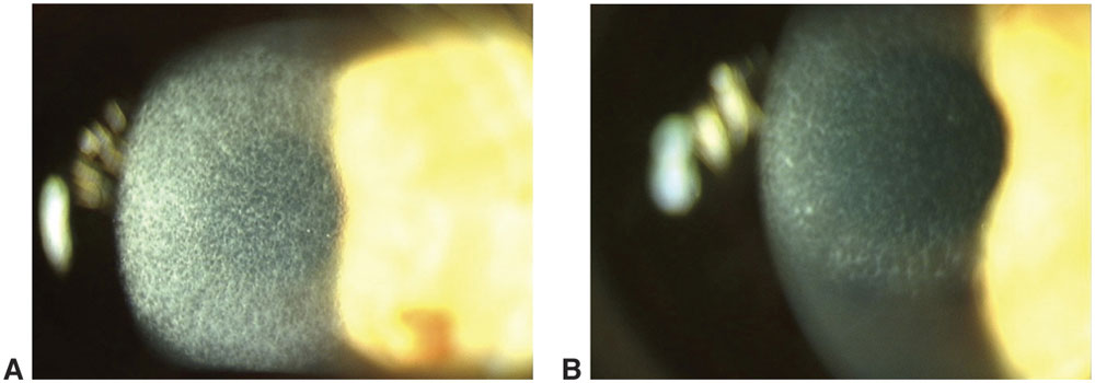 Photoablation Plications And Adverse Effects Ento Key