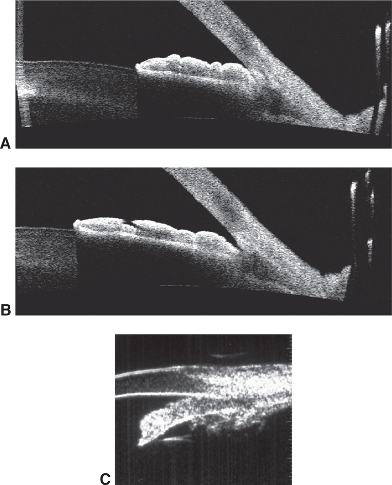 Angle Closure Glaucoma Ento Key