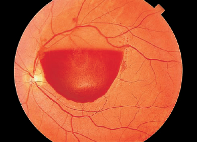 Donut-Shaped Subhyaloidal Hemorrhage - Retina Today