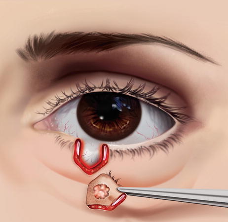 Eyelid reconstruction shop