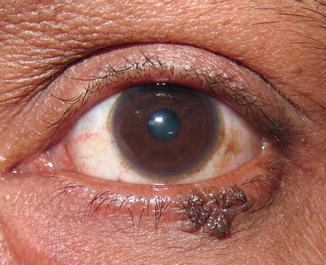 Benign Eyelid Lesions