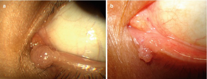 benign papillomatous lesion