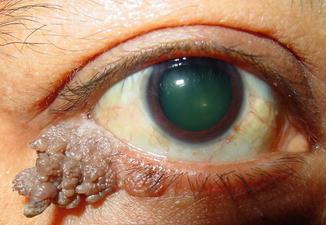 papilloma eyelid