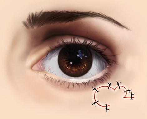 Flaps In Eyelid Reconstruction | Ento Key