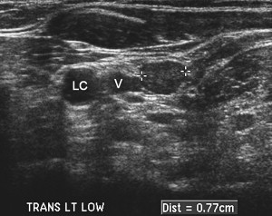 thyroid ultrasound recurrent disease fig