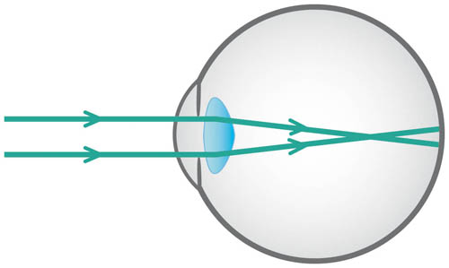 Figure3.2_Myopia