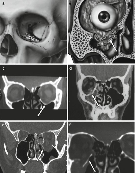 Orbital Floor Fractures | Ento Key