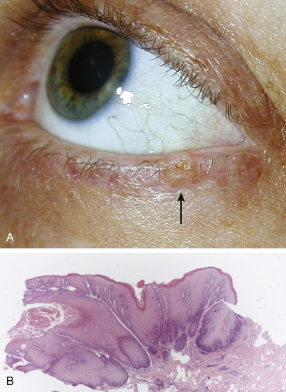 Benign And Premalignant Tumors Of The Eyelid | Ento Key