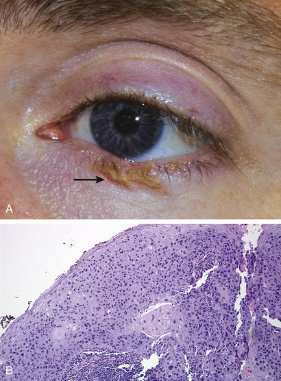 Benign And Premalignant Tumors Of The Eyelid | Ento Key