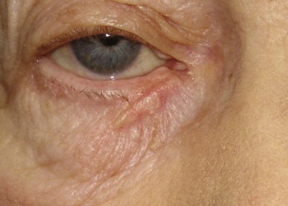 Malignant Tumors Of The Eyelid | Ento Key