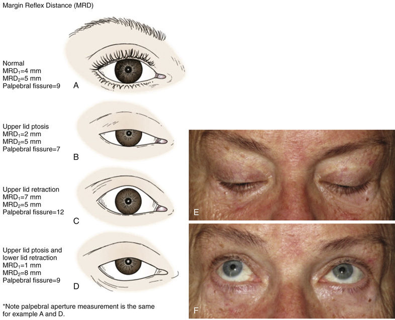 Upper Eyelid Ptosis And Retraction | Ento Key