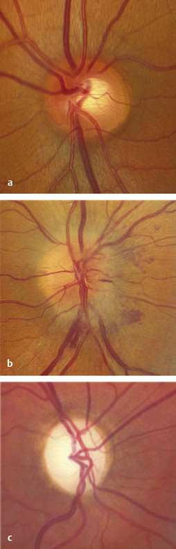 Optic Neuropathies | Ento Key