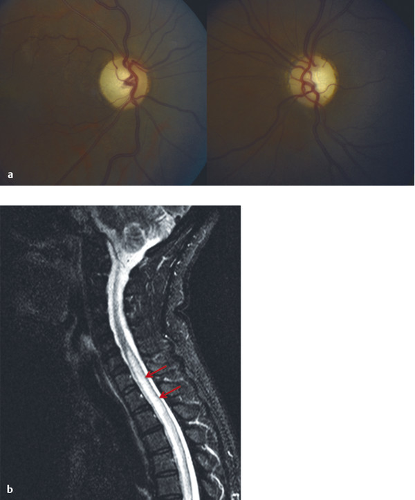 Optic Neuropathies | Ento Key