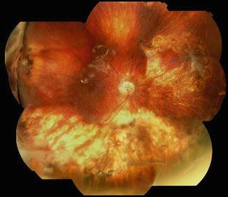 Management Of Proliferative Vitreoretinopathy | Ento Key