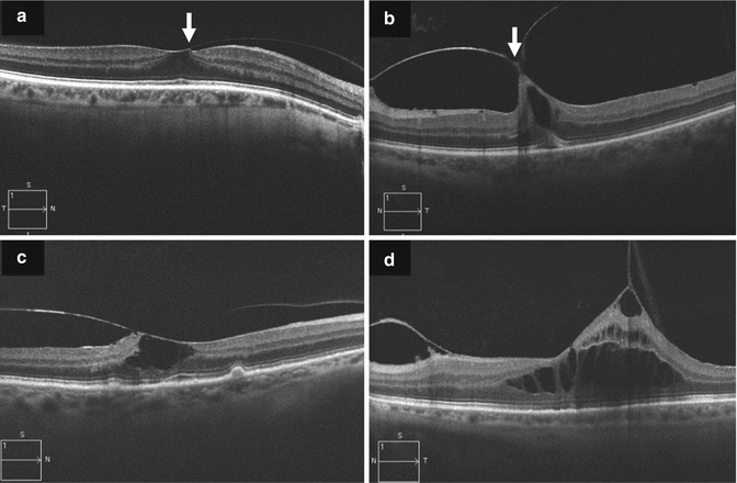 Vitreomacular Traction And Epiretinal Membranes | Ento Key