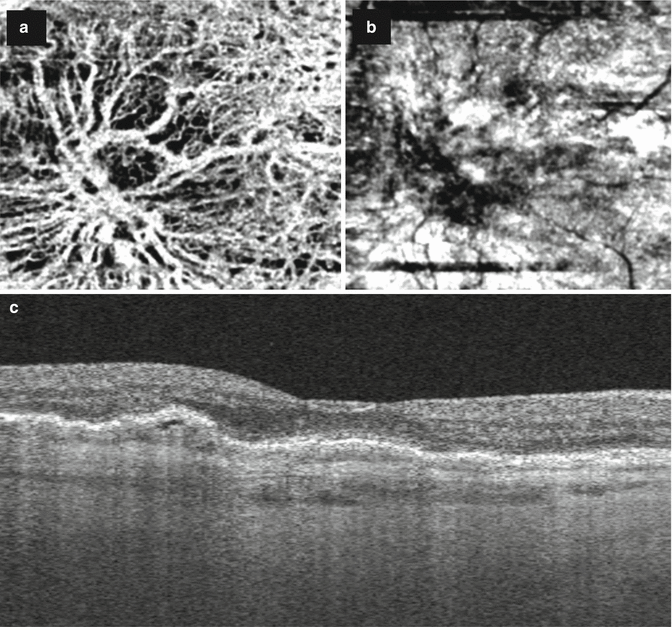 Swept-Source Optical Coherence Tomography | Ento Key