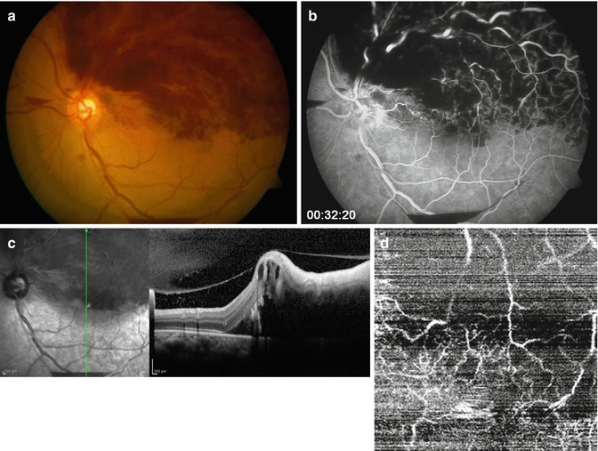 Optical Coherence Tomography Angiography | Ento Key