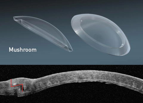 Surgical Correction Of Keratoconus: Different Modalities Of ...