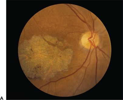 Differential Diagnosis Of Age-Related Macular Degeneration | Ento Key