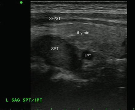 Parathyroid Nodule Ultrasound