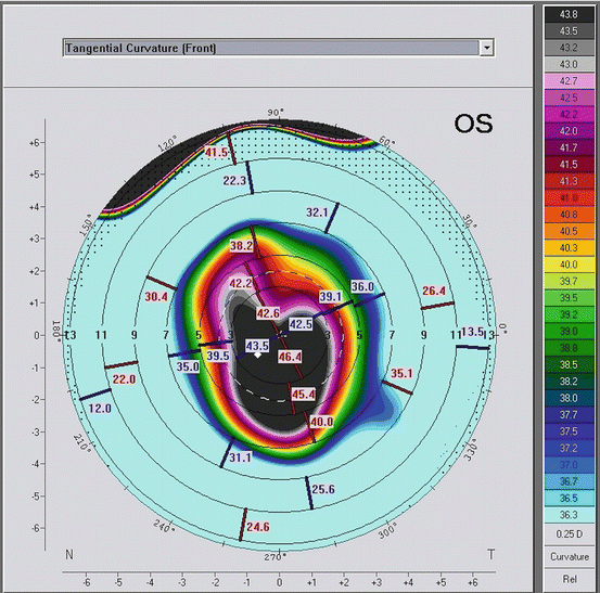 Patterns And Classifications In Ectatic Corneal Diseases | Ento Key