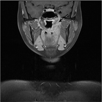 Inflammatory Pseudotumor Of The Nasopharynx With Spread Along The ...