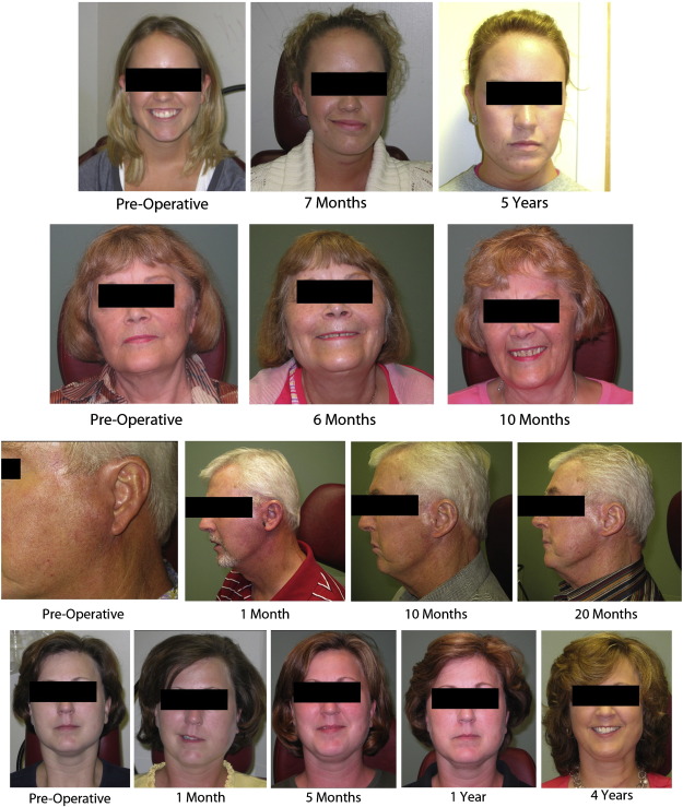 Free Dermal Fat Graft Reconstruction Of The Head And Neck: An Alternate ...