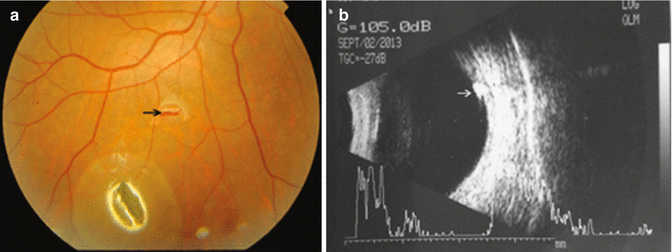 Intraocular Foreign Bodies | Ento Key