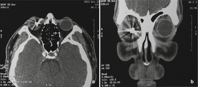 Intraocular Foreign Bodies | Ento Key