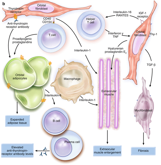 Management Of Dysthyroid Optic Neuropathy | Ento Key