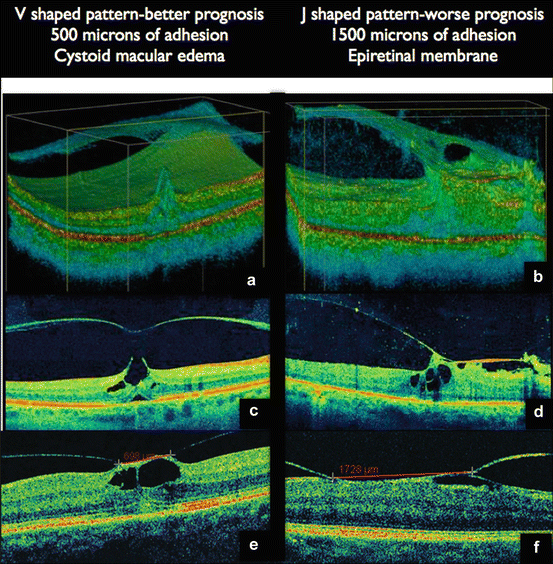 Surgical Management Of CME Associated With Vitreoretinal Interface ...